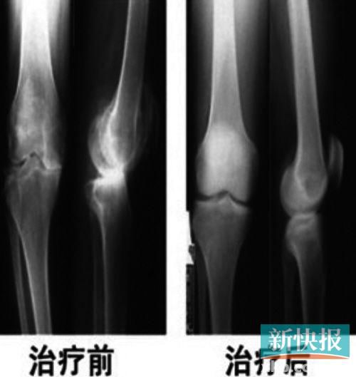 北京协和老中医60年研制奇方,专治膝关节病,针对病因,钝化骨刺,修复软骨