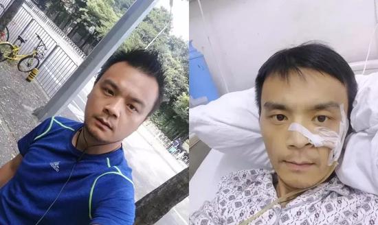 刘凌峰患病前后对比照