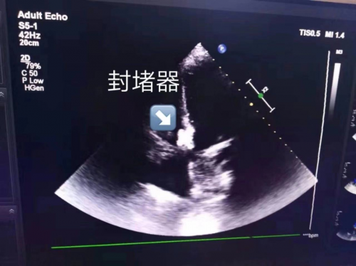 山西万峰医院心内科专家成功救治先天性心脏病