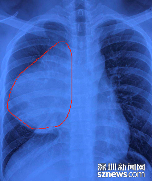 深圳21岁小伙反复咳嗽一个月 劈开胸骨发现“西