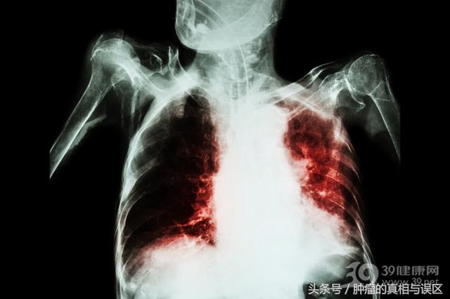胸外科主任：有这4种病赶紧戒烟，下一个找你的可能是肺癌