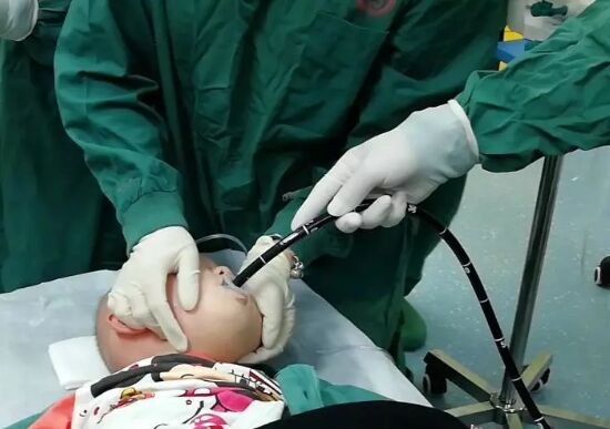 一岁幼童纽扣电池卡喉医务人员深夜紧急手术