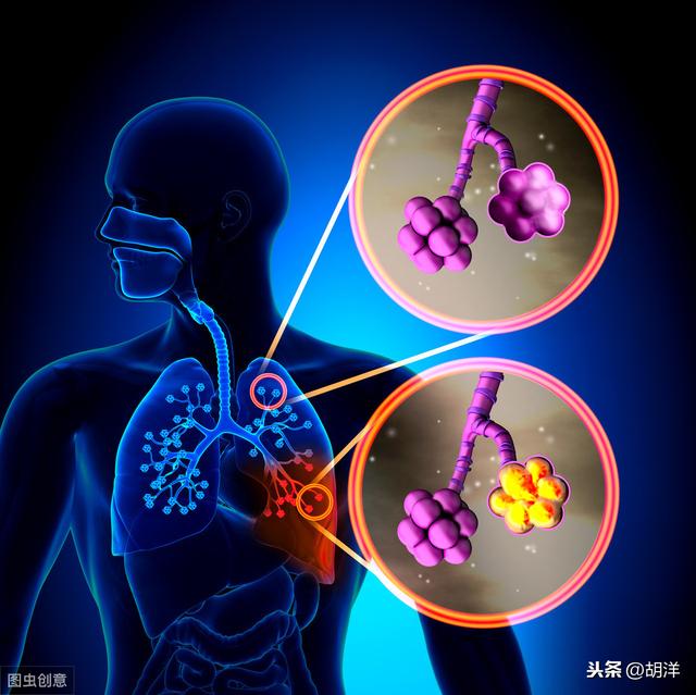 胸背痛就是肺癌？大部分没有相关性，这5种疾病才是最常见病因