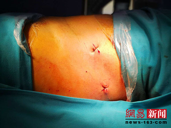 首例机器人骨科手术在沧州这家医院完成