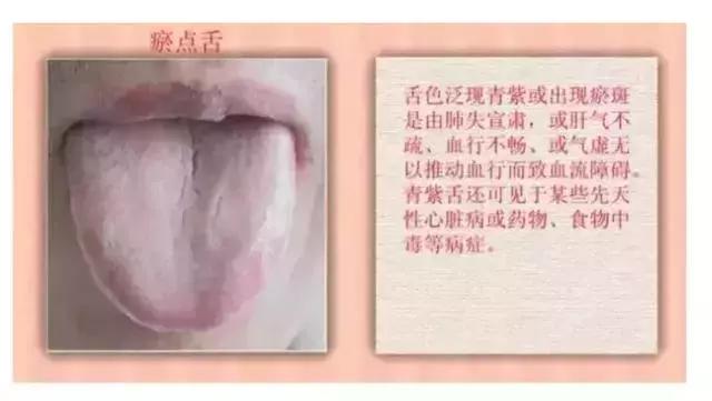 舌诊图谱，中医看舌头到底都在看什么？教你自己认识舌图