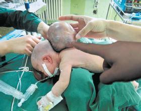 揭秘小儿神经管畸形的元凶，让你孕育健康宝宝