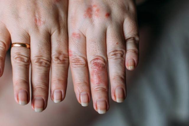 湿疹为何“赖上”你？警惕皮肤上突然出现的“小红点”，很可怕
