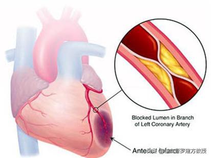 “心脏病”和“冠心病”是同一种病吗？心血管专家为你解答