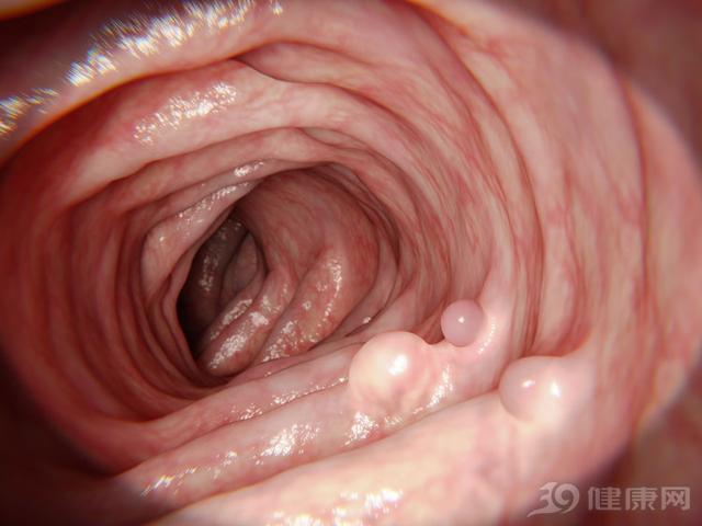 辟谣丨结肠“变黑”，是肠癌前兆吗？消化内科医生给出解释