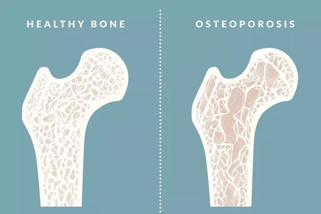 90%以上的老年骨折都是“它”造成的，是时候快把钙补起来了