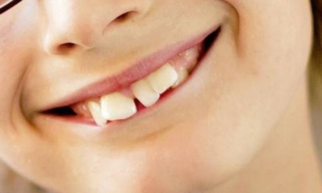 儿童换牙期这些不良习惯，直接导致牙齿不齐，家长们要注意了